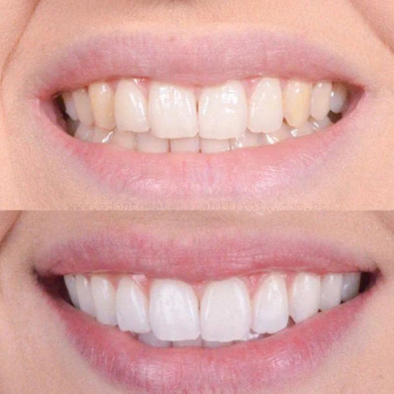 Blanqueamiento Rápido de Dientes para una Sonrisa Radiante