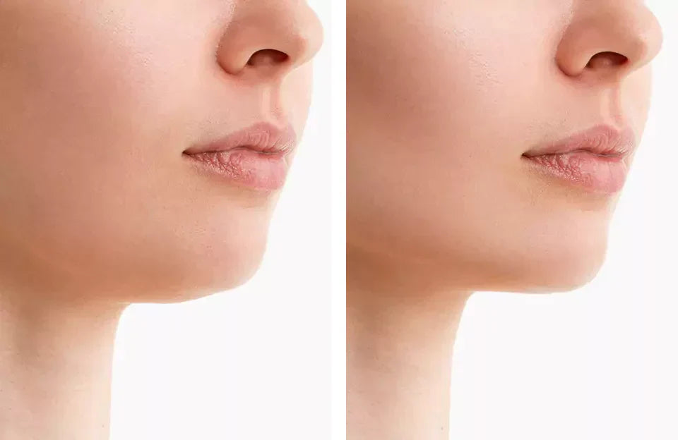 Cinturón de Terapia de Luz Roja NovaLume ChinContour para Doble Papada