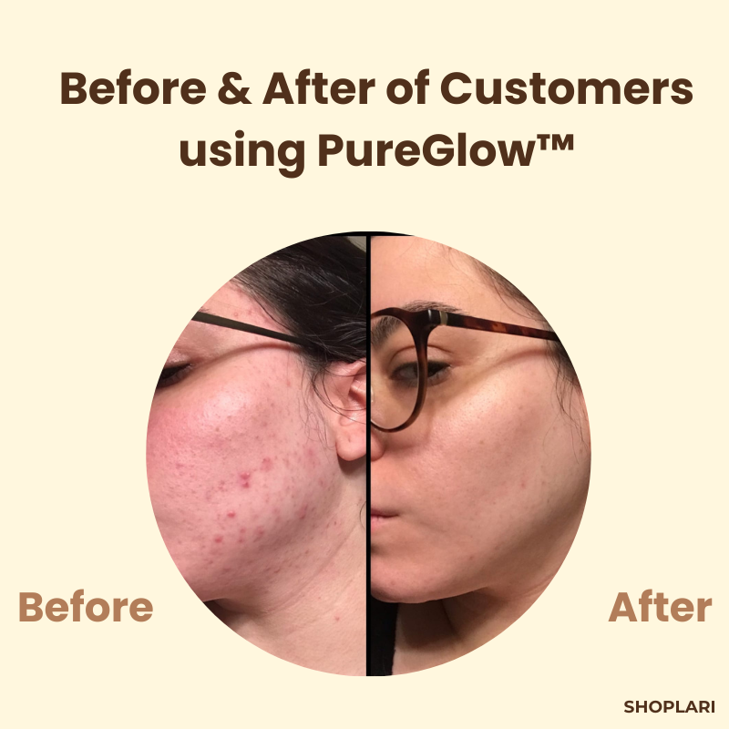 1+1 Gratis Mascarilla de Té Negro PureGlow™