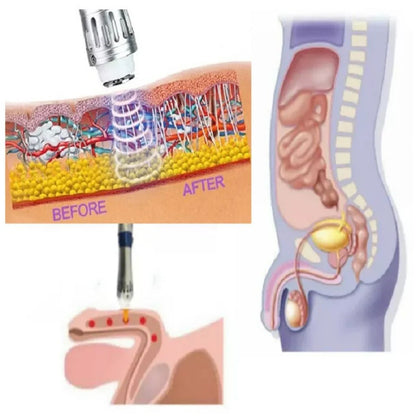 Dispositivo portátil de terapia de ondas de choque VitaPulse para hombres