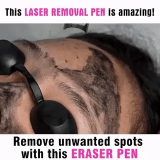 Lápiz Láser LumiDerm para la Eliminación de Tatuajes, Lunares y Pecas