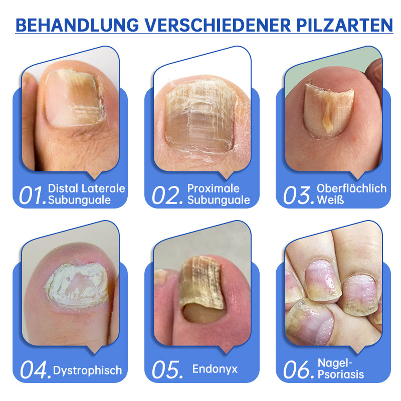 NailCure™ - Solución de Tratamiento Láser para Hongos en las Uñas (50% DESCUENTO)