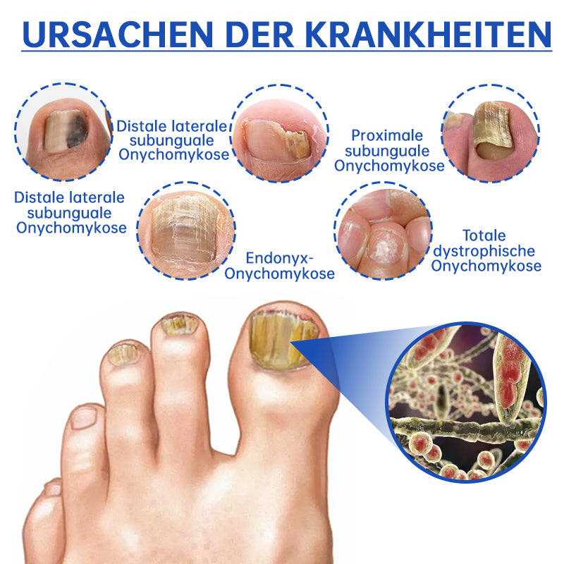 NailCure™ - Solución de Tratamiento Láser para Hongos en las Uñas (50% DESCUENTO)