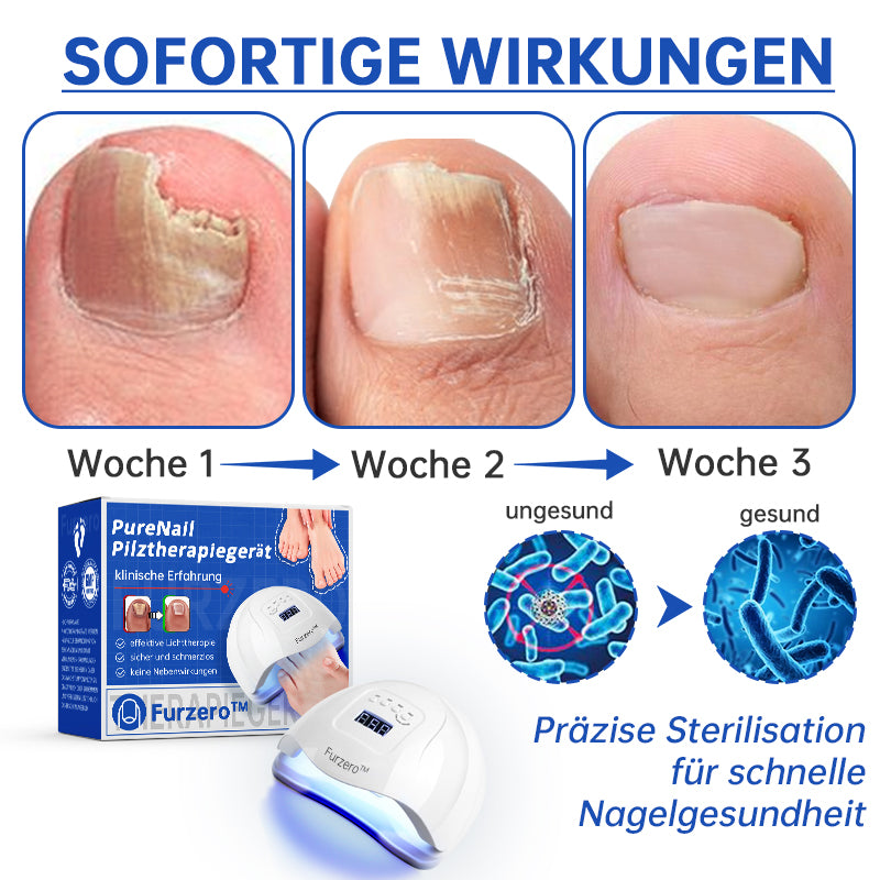 NailCure™ - Solución de Tratamiento Láser para Hongos en las Uñas (50% DESCUENTO)