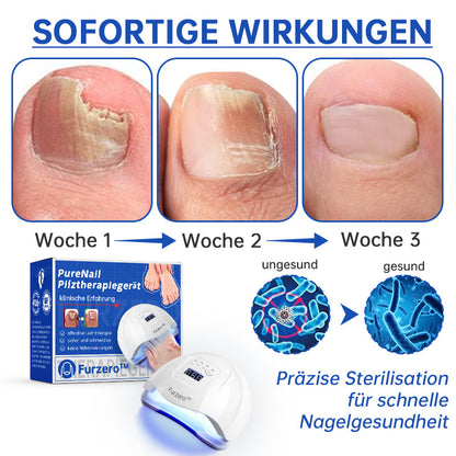 NailCure™ - Solución de Tratamiento Láser para Hongos en las Uñas (50% DESCUENTO)