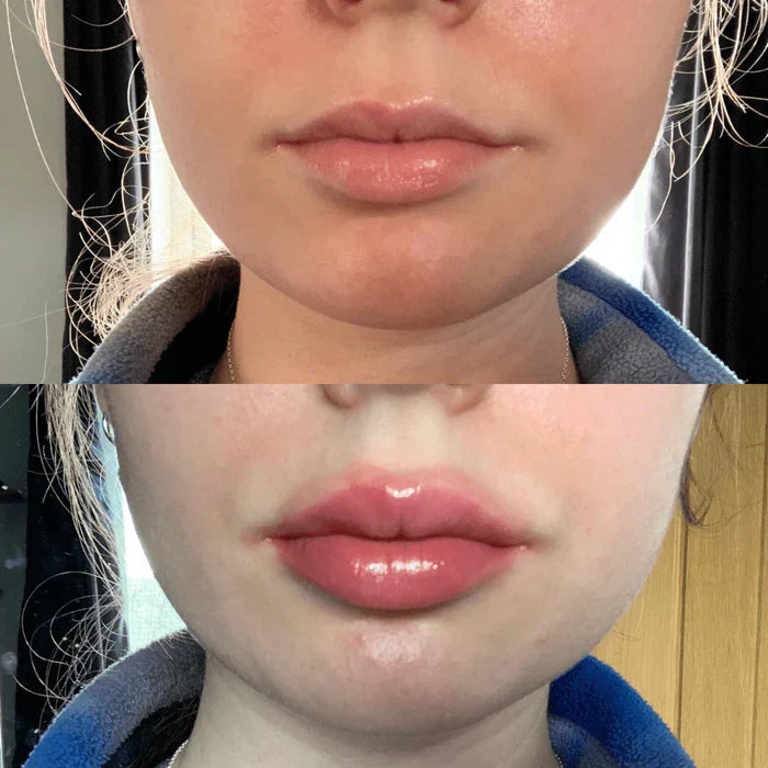 Suero Instantáneo para Aumentar los Labios