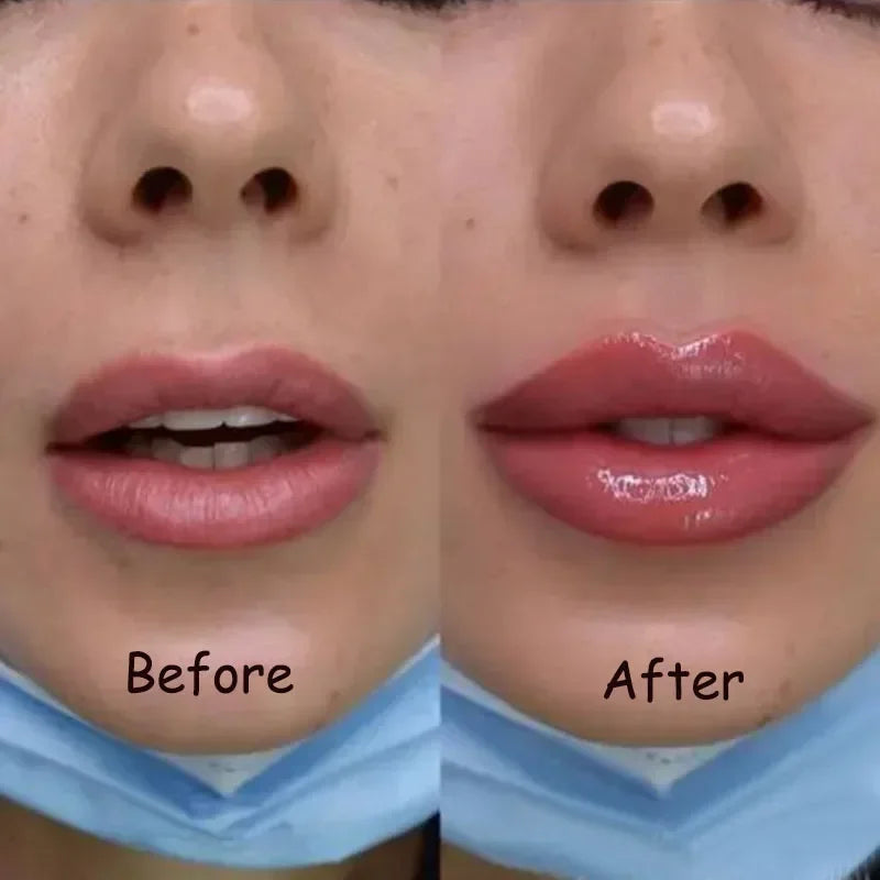 Suero Instantáneo para Aumentar los Labios