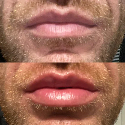 Suero Instantáneo para Aumentar los Labios