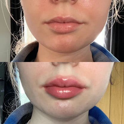 Suero Voluminizador de Labios LumaGlow Instantáneo para Labios Más Llenos