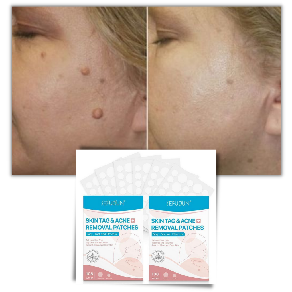 VierraSol | Parche para la piel - ¡Elimina lunares y verrugas de forma natural!
